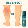 Varicose-Veins-Spray-30-Ml1-1773307662 Varicose Veins Spray 30 ML