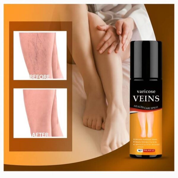 Varicose-Veins-Spray-30-Ml2-1773307662 Varicose Veins Spray 30 ML