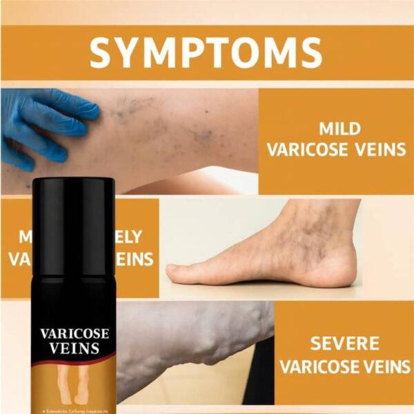 Varicose-Veins-Spray-30-Ml3-1773307663 Varicose Veins Spray 30 ML
